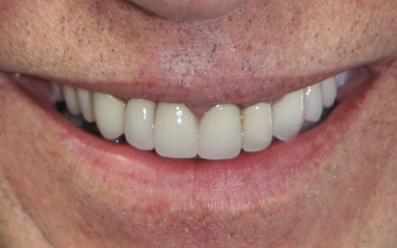After JRFD smile treatment beautiful smile results
