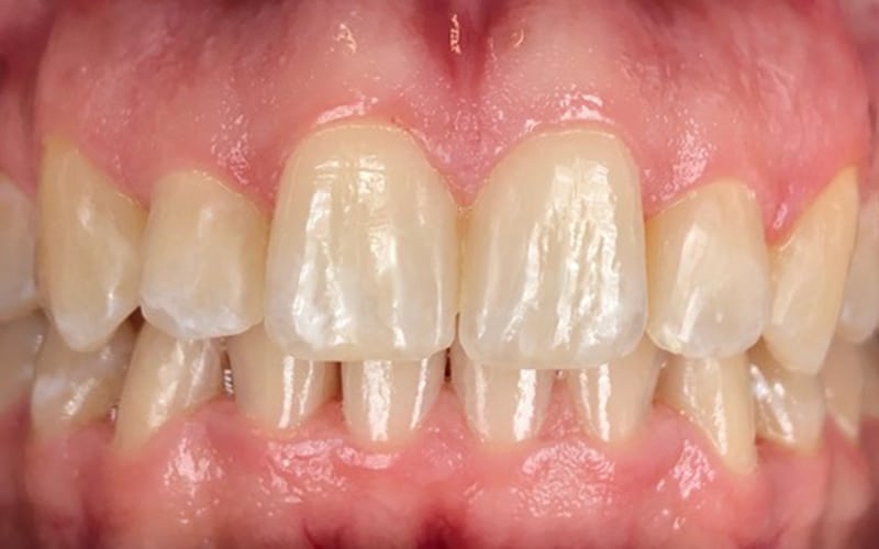 James River Family Dentistry Invisalign After
