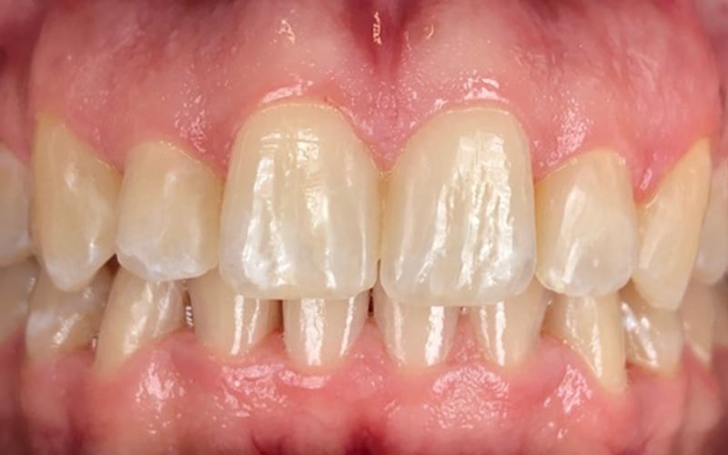 Our results 49 James river family dentistry invisalign after