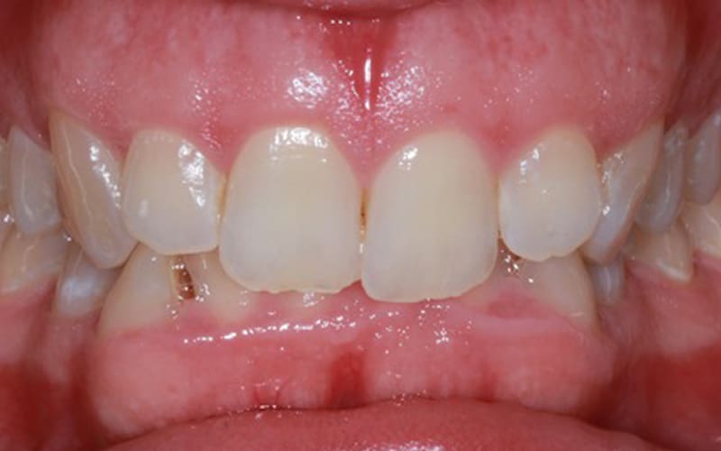 Our results 48 James river family dentistry invisalign before