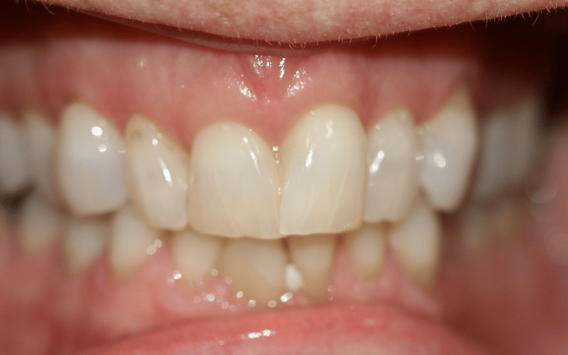 Our results 46 Before invisalign with jrfd