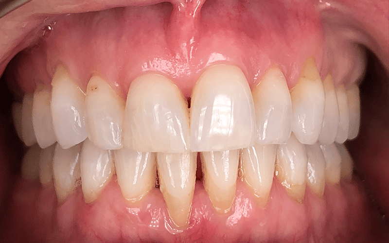 Our results 47 After invisalign with jrfd