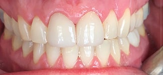 Our results 23 Jrfd crown 3 after