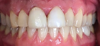 Our results 22 Jrfd crown 3 before