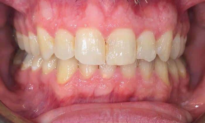After image of straightened teeth with Invisalign