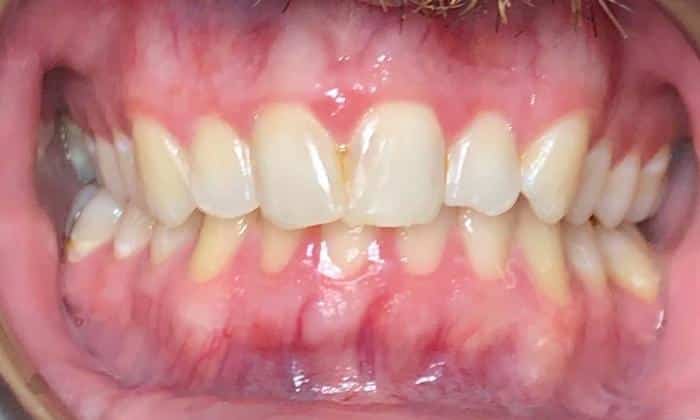 Before image of straightened teeth with Invisalign