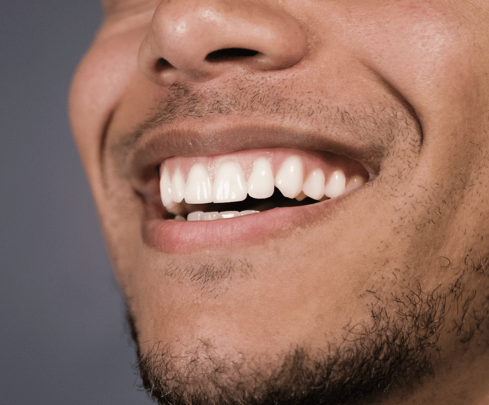 Periodontal-disease Periodontal maintenance