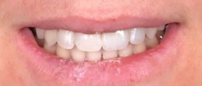 Multidisciplinary case-after-treatment-smile Smile, treatment, dentist