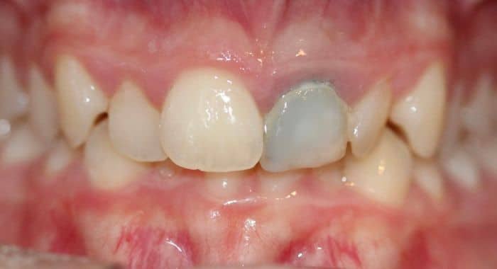 Our results 18 Before treatment to complete tooth repair