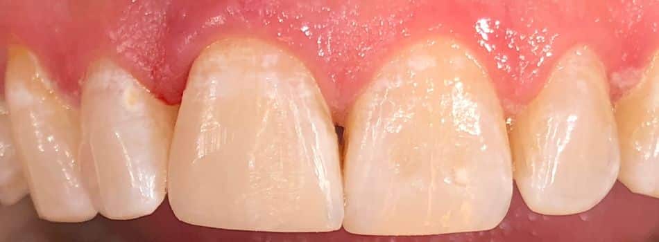 Our results 11 Same day chip tooth repair