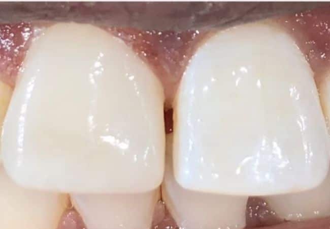 Our results 3 Filling in front tooth dentist
