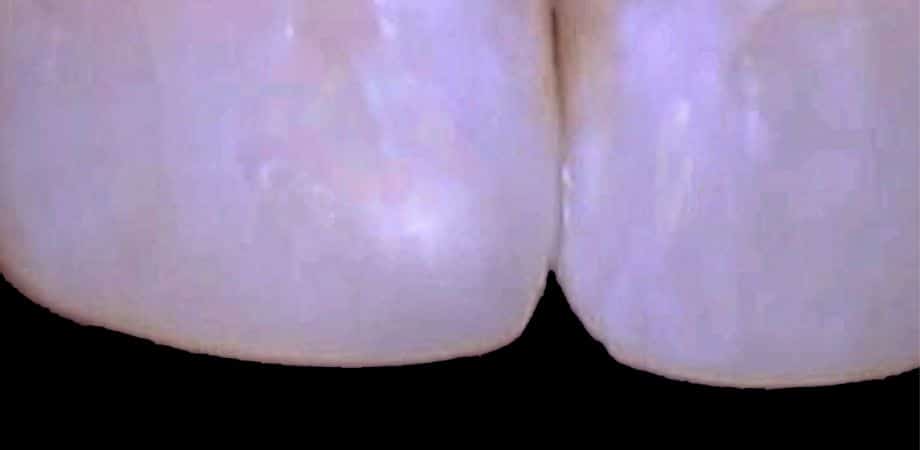 Our results 5 Same day repair after chip tooth