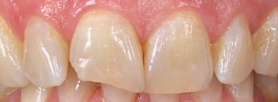 Our results 10 Same-day composite dentist