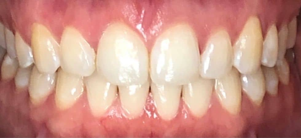 Our results 13 Smile transformation invisalign and gingival recontouring