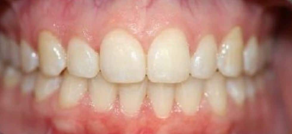 smile transformation Invisalign and gingival recontouring