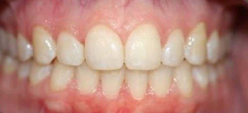 Our results 12 Smile transformation invisalign and gingival recontouring