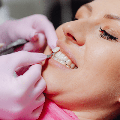 Veneers vs crowns: which is right for you? 6 Woman getting cosmetic teeth work done at the dentist, representing veneers vs crowns