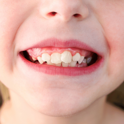 Cosmetic dentistry for crooked teeth 5 Little kid's crooked teeth, representing
