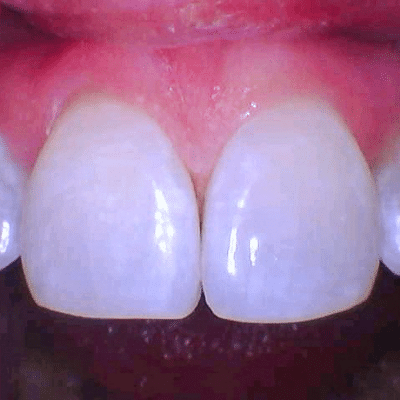 How to protect teeth from acid erosion 7 Closeup of patient's two front teeth, representing how to protect teeth from acid erosion