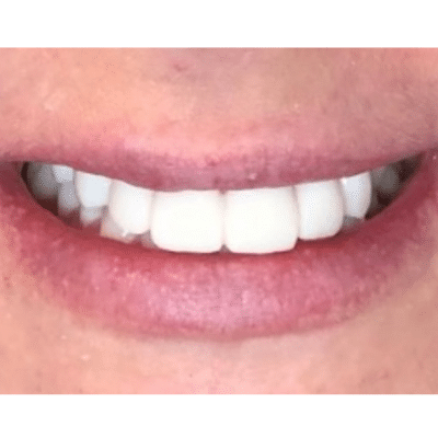 Professional dental cleaning in richmond va: why it’s essential for a healthy smile 8 Closeup of patient's white teeth, representing professional dental cleaning in richmond va