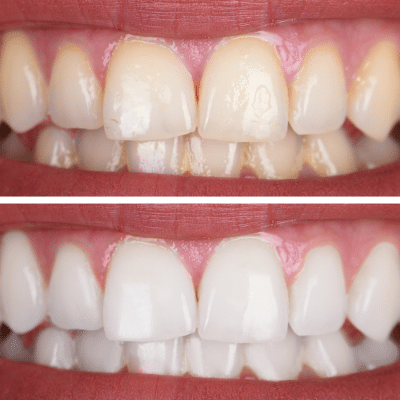 Teeth whitening myths debunked 2 Before and after teeth whitening results, representing teeth whitening myths